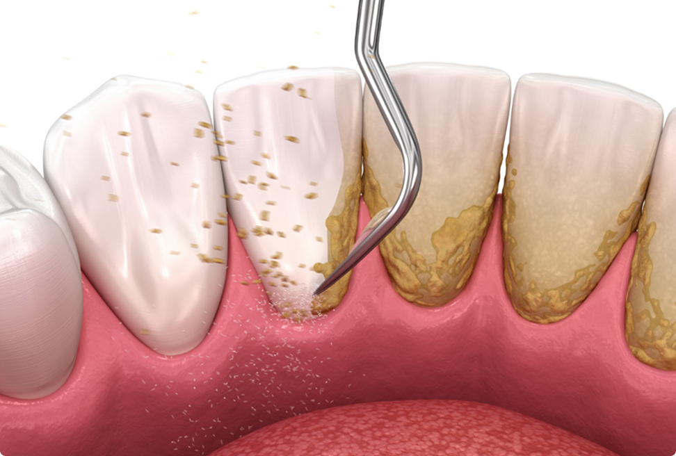 笑気吸入鎮静法