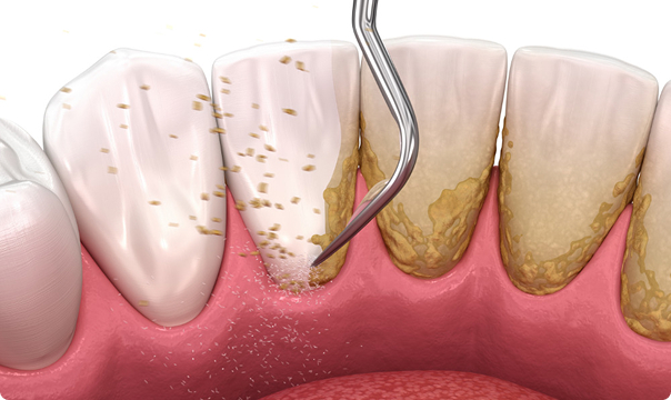保険の総入れ歯