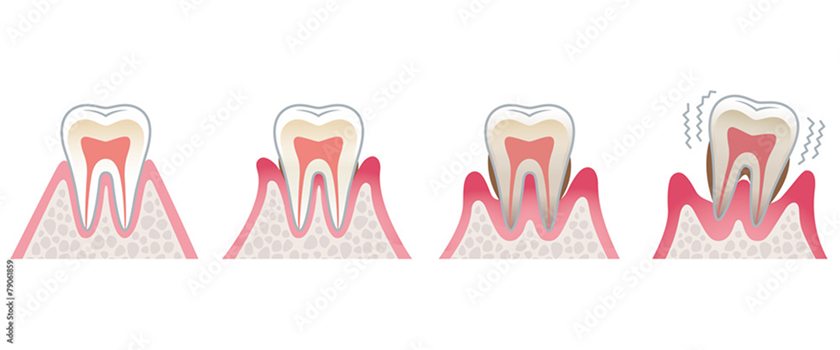 歯周病とは